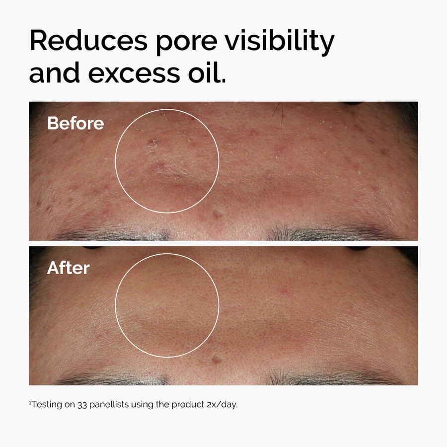 niacinamide-10-zinc-1-y8 ord-niacinamide-zinc-blemish-serum-before-after-pores.jpg