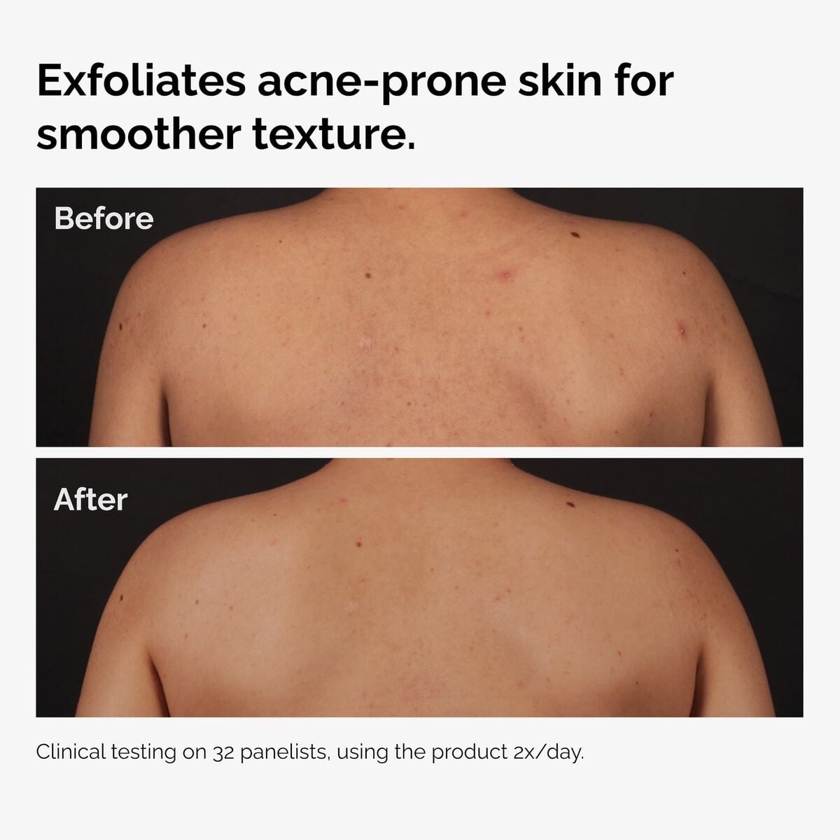 salicylic-acid-0-5-body-serum-s5 ord-salicylic-acid-body-serum-before-after-graphic-NA.jpg